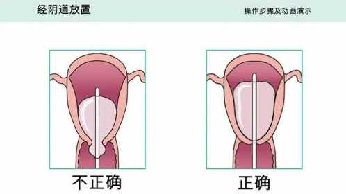 子宫填塞球囊操作