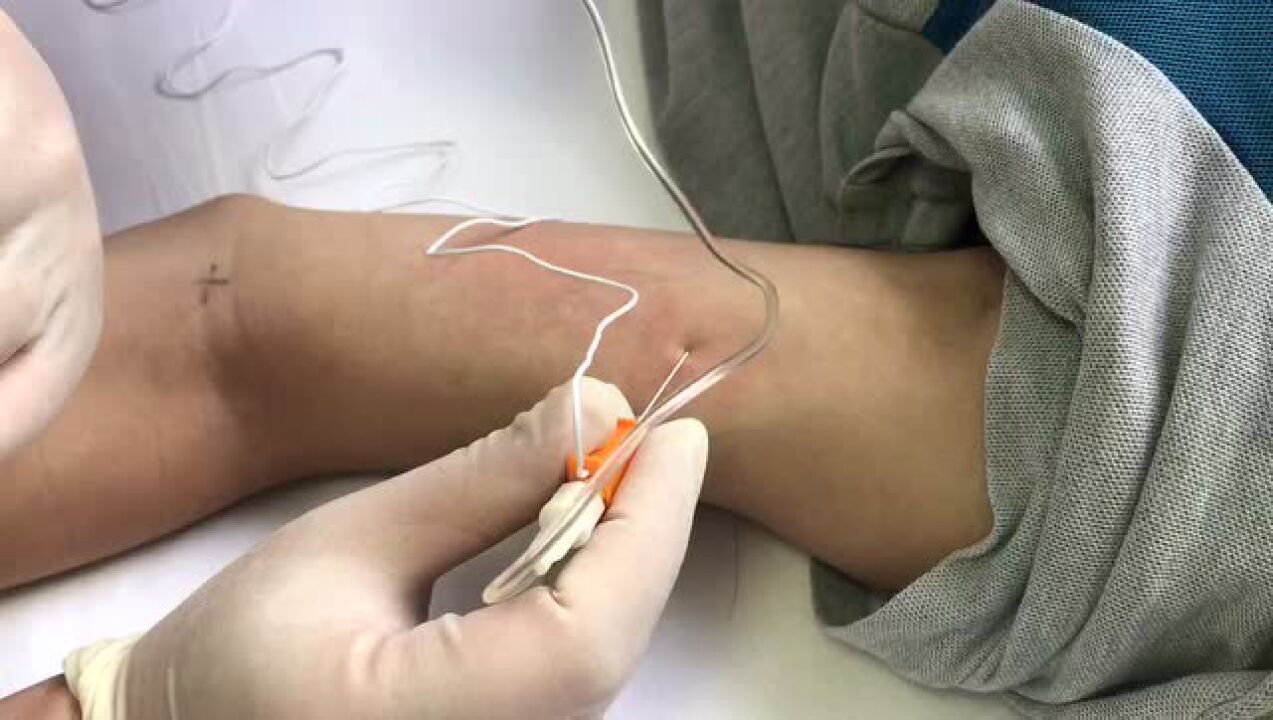 肉毒毒素注射肱二头肌