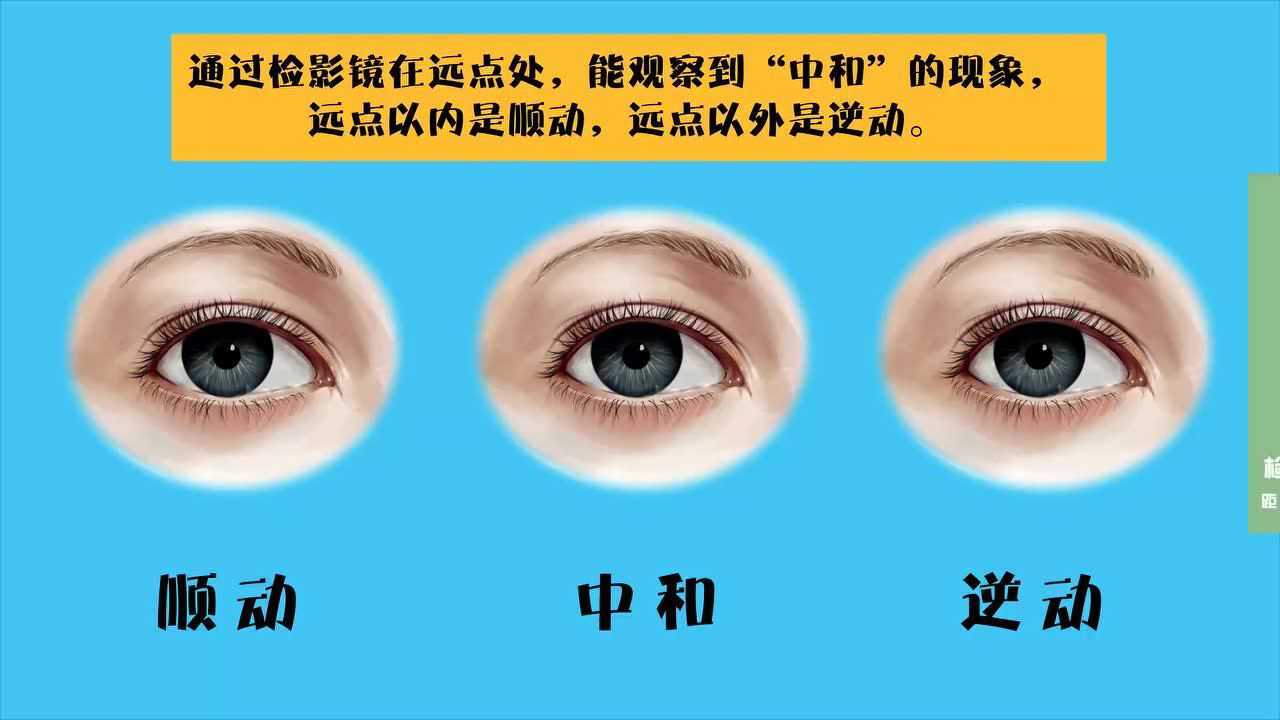 检影验光-用检影镜对单纯近视进行检影_高清