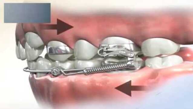 钢丝?弹簧?螺丝?他们能矫正牙齿吗