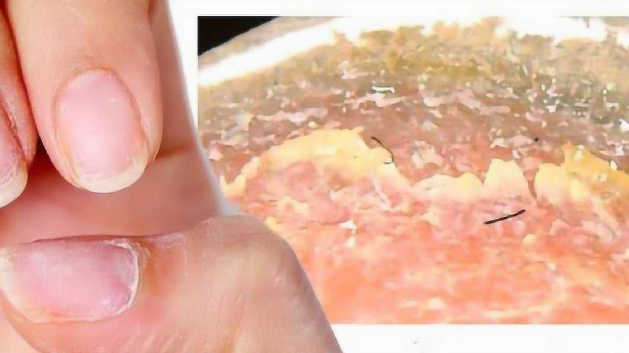 灰指甲真菌图片显微镜图片