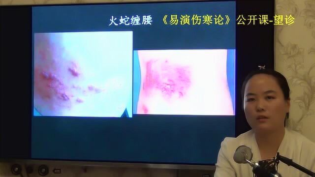 161中医望诊望腹部皮肤发红主热证火蛇缠腰腹水红纹易演伤寒论