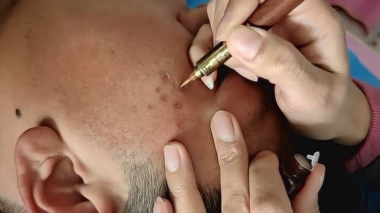 真实祛痣全过程,当它被烧完的一瞬间,我看着都想吐_腾讯视频