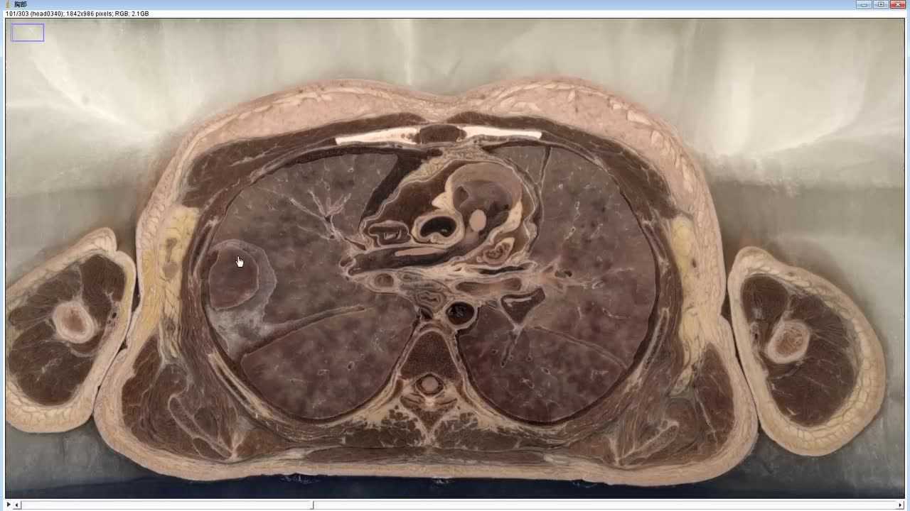 肺根内结构排列2020年05月02日259次播放断面解剖段支气管2020年05月