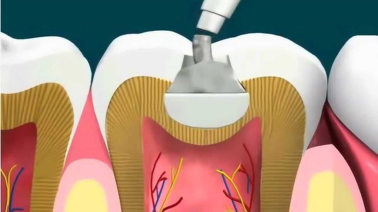 補牙為什麼不疼?看看動畫演示樹脂補牙的過程,你就明白了!