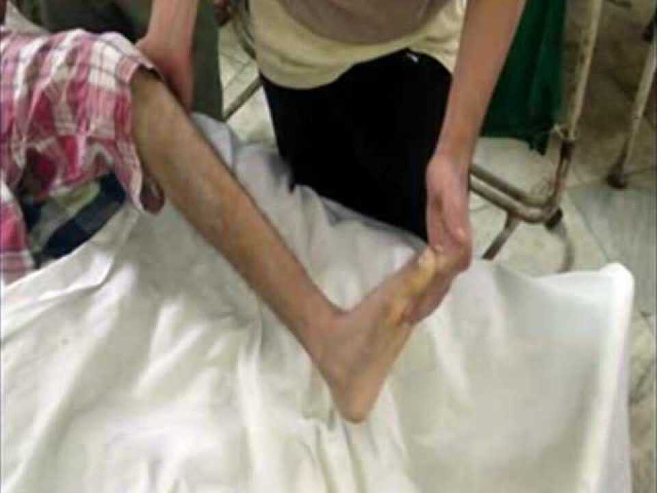 踝阵挛与反射亢进_高清