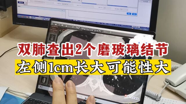 双肺2个磨玻璃结节,左侧1cm估计会长大,建议小范围手术切除