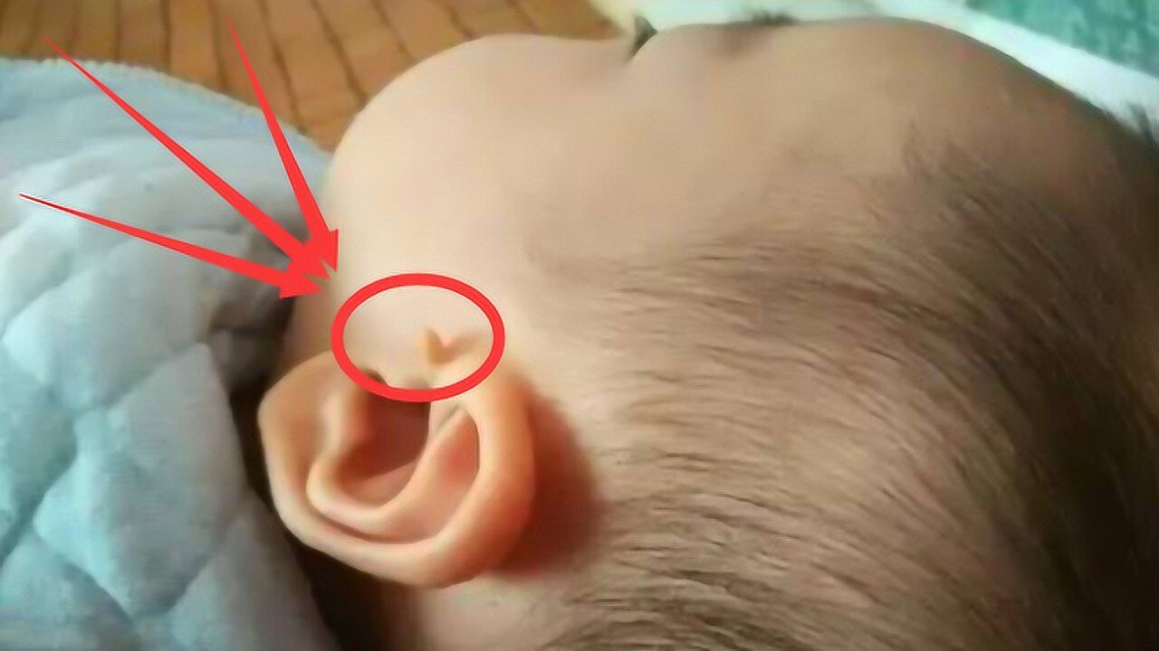 耳朵长"拴马桩",真的是天生福气相吗?专家解答刷新认知