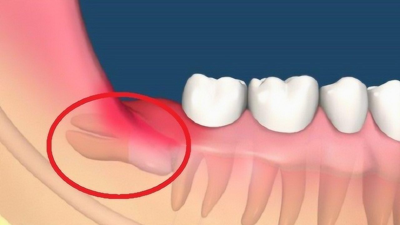 如果智齿横着长该怎么拔掉镜头记下全程隔着屏幕都觉得疼