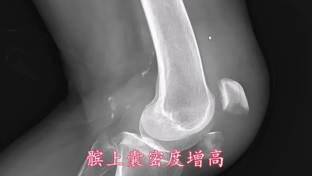 膝关节解剖,膝关节X线片怎么看?医生讲解——全是干货腾讯视频