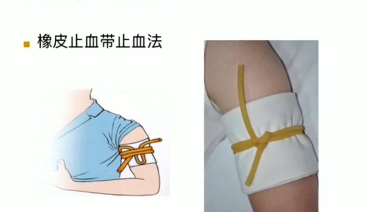 止血带止血法_高清1080P在线观看平台_腾讯视频