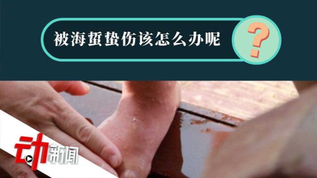 辽宁一浴场10余人被海蜇蛰伤:十招教你应对“蛰伤”