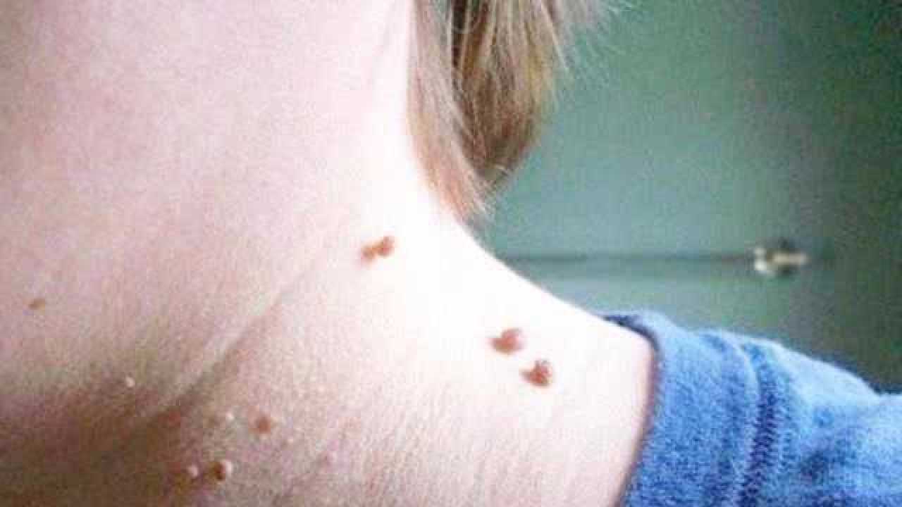 身上长了瘊子太苦恼?教你几个去除瘊子的方法,学到就是赚到