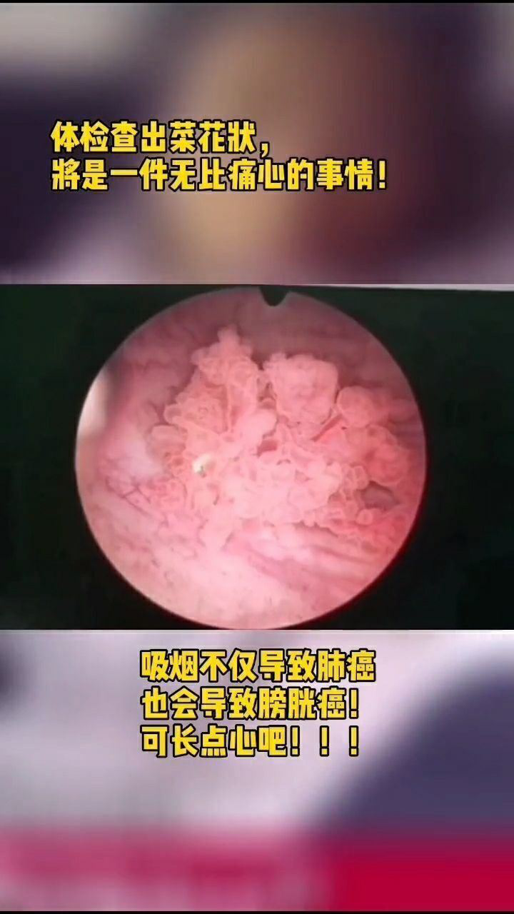 肿瘤菜花状图片