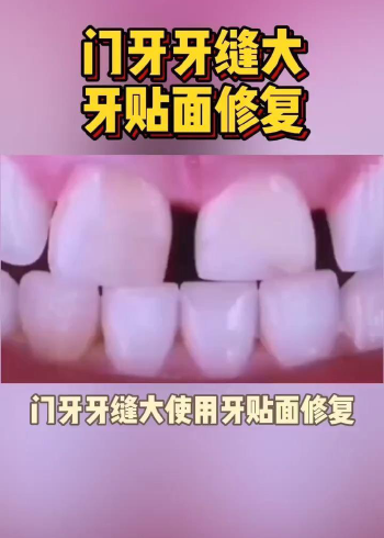 门牙牙缝大怎么修补最好?