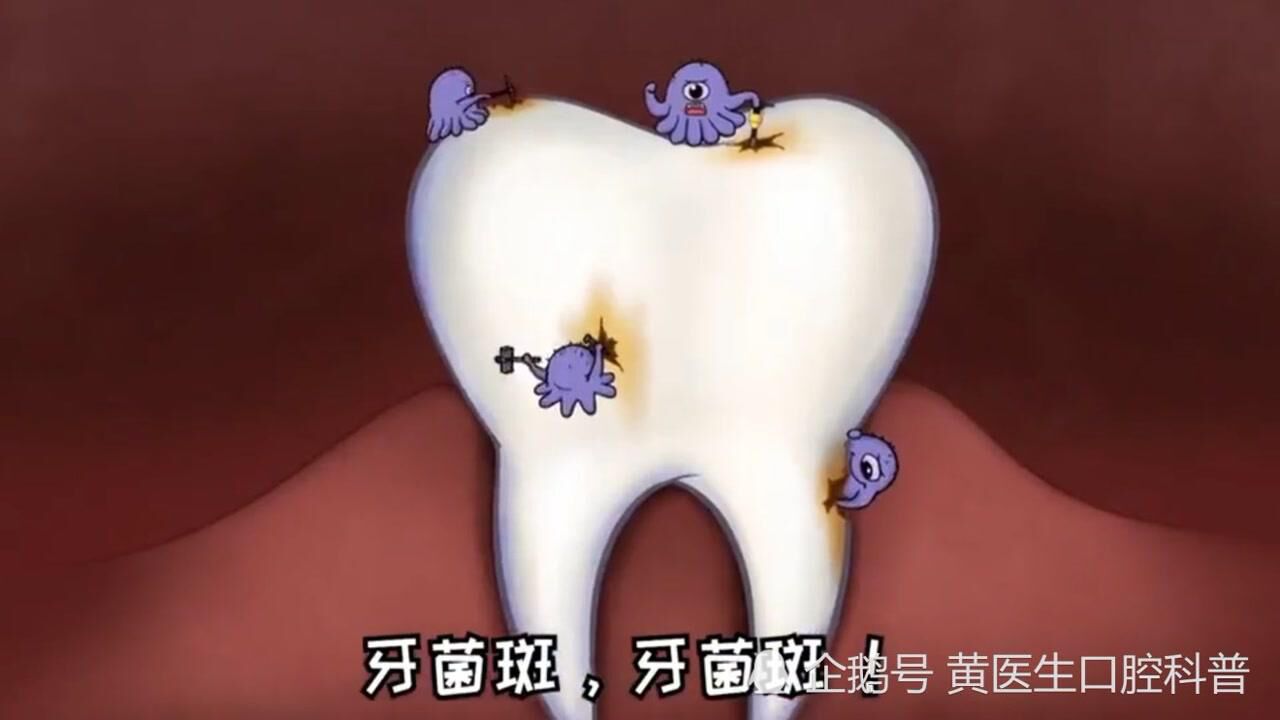科普—口腔健康小常识-牙菌斑！_高清