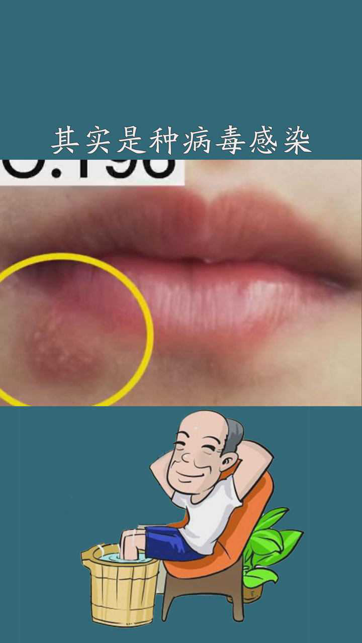 婴儿口角炎怎么治疗图片