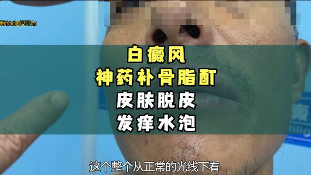 成都白癜风医院喻明江白癜风神药补骨脂酊皮肤脱皮发痒水泡