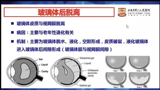 眼球先天性和退行性病变的影像学诊断上海市第一人民医院王悍