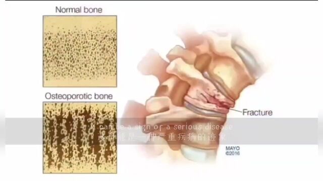 梅奥诊所骨质疏松纪要
