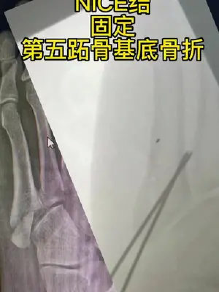 #nice结#第五跖骨基底骨折#医学科普#微创手术_腾讯视频