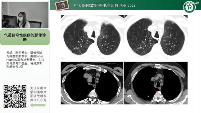 气道狭窄性疾病的影像诊断中大常娣