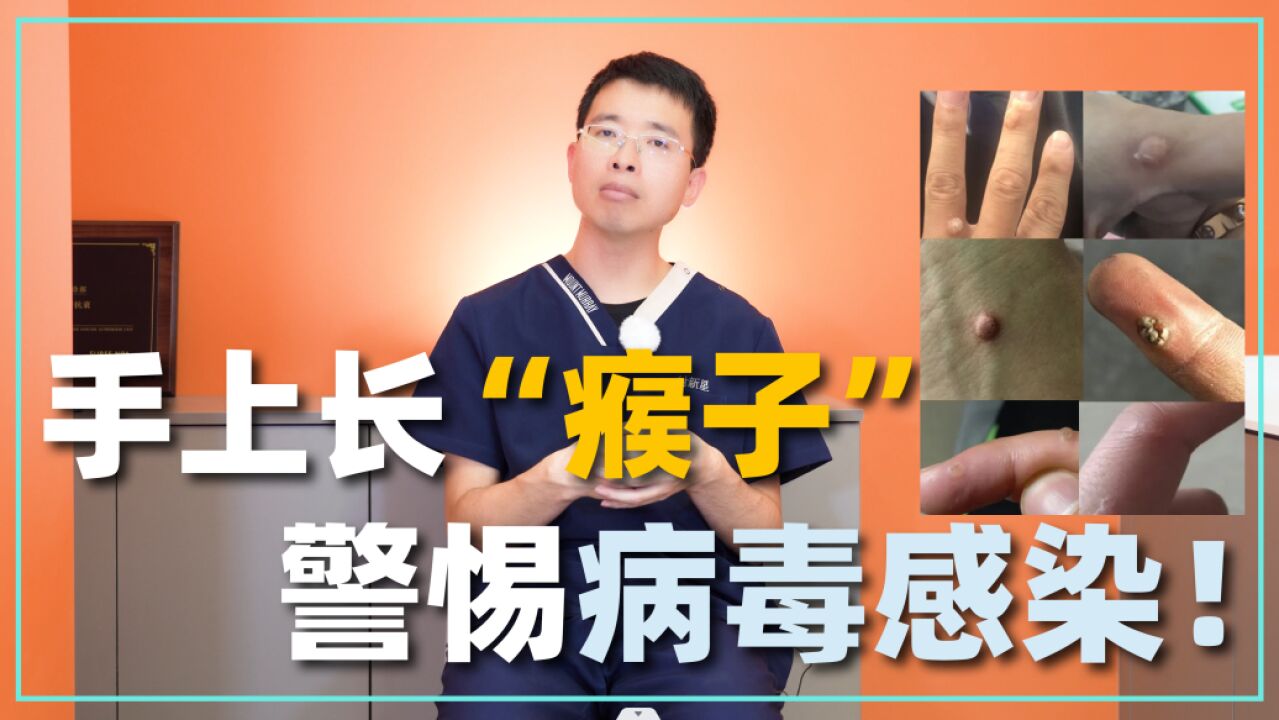 手上长“瘊子”,要小心病毒感染!医生教你如何识别快速治疗_腾讯视频