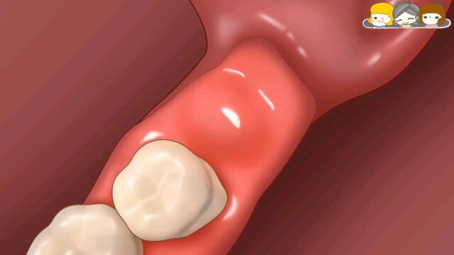 阻生智齿拔除术!