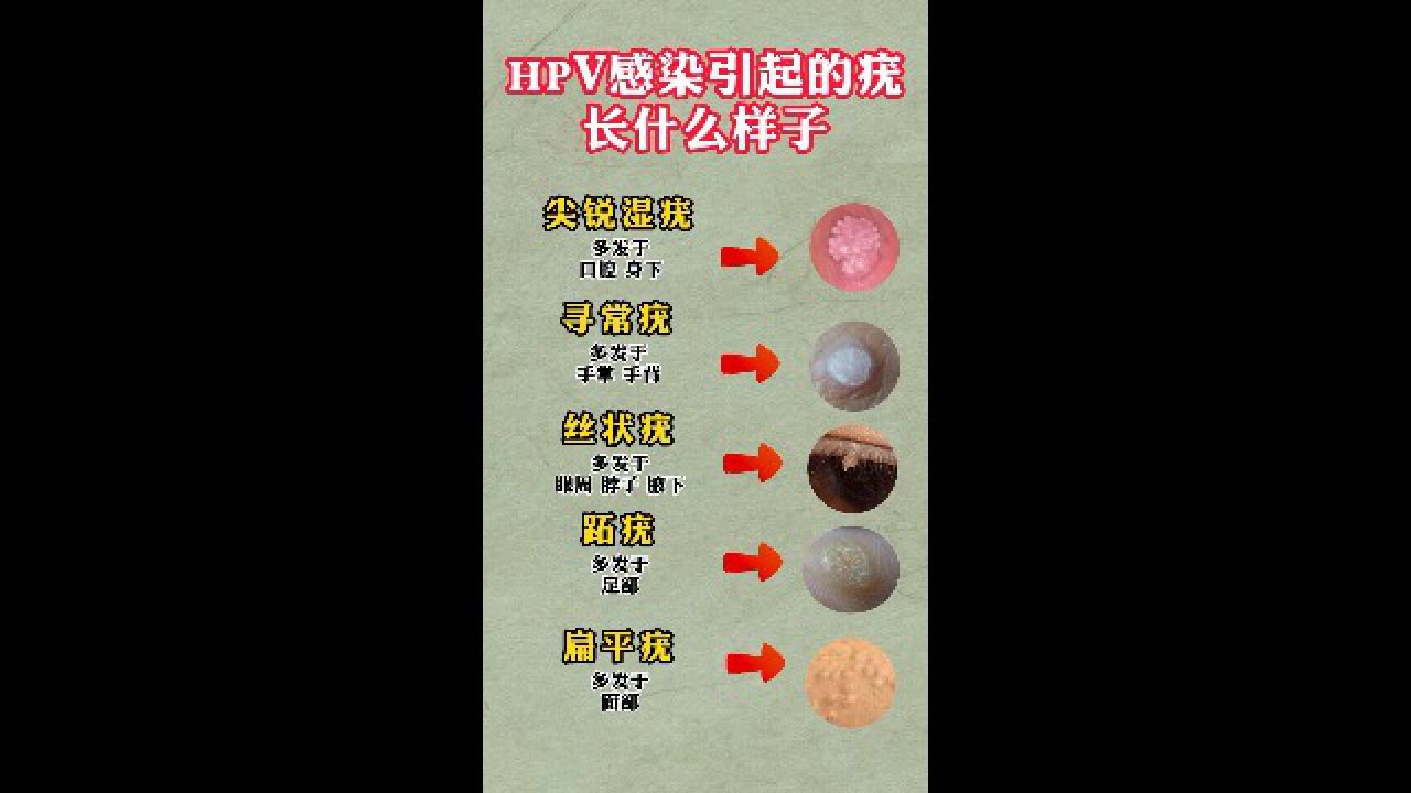 hpv感染引起的疣长什么样子 南京华肤医院