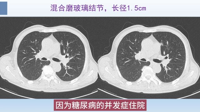 肺结节CT科普,2个细节提示肺癌风险高,可以积极点