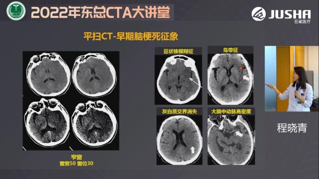 脑卒中CT成像技术及应用东部战区总医院程晓青