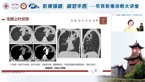 肺空洞性病变的影像分析_四川大学华西医院余建群