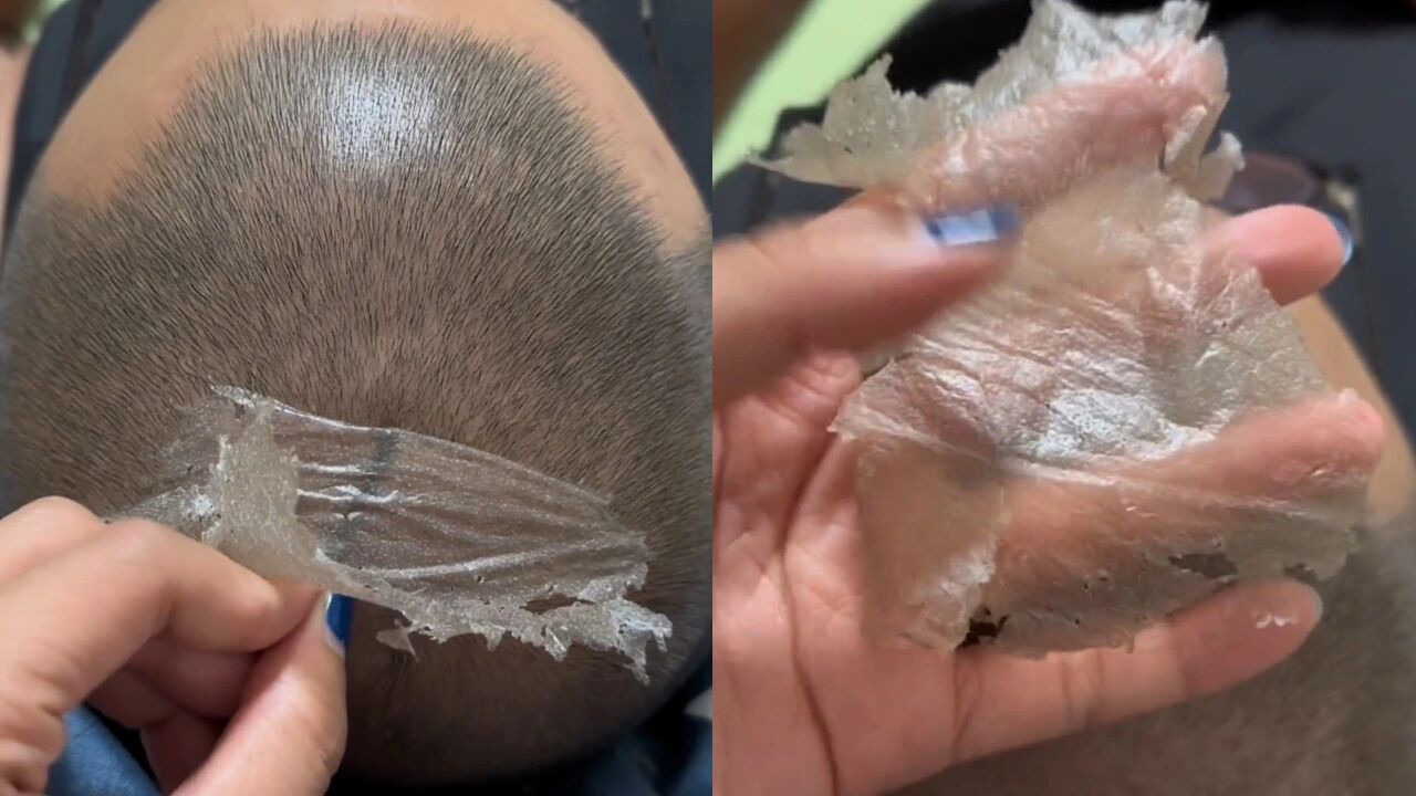 女子帮老公挠头顶解痒,不料撕下超大一块头皮,头顶瞬间光洁如新