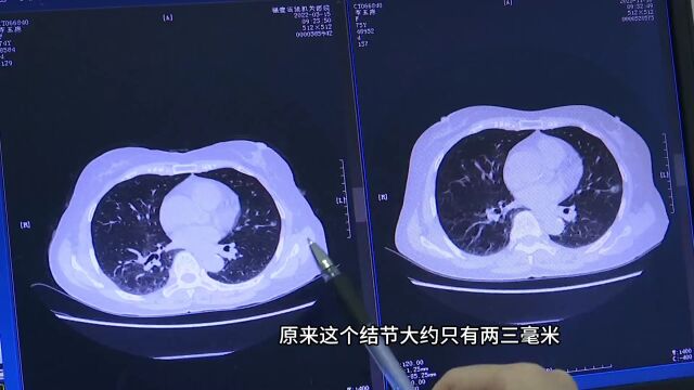 男子2毫米肺结节3年后变肺癌 医生教您看图识肺癌