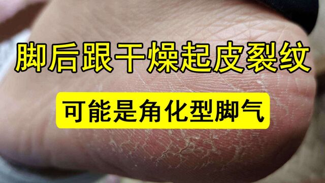 脚后跟干燥起皮长白纹,这可能是角化型脚气惹的祸