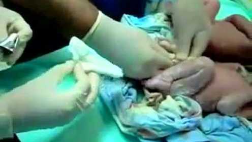 双胞胎出生后 医生给两个宝宝护理的全过程