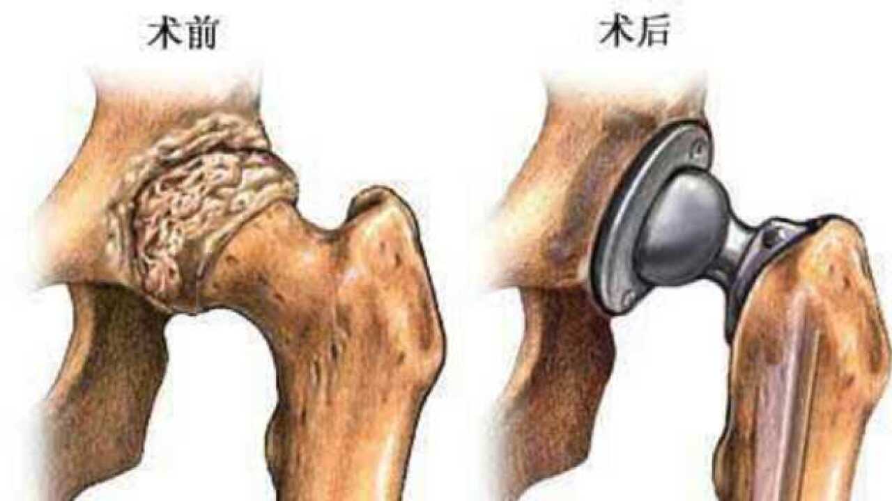1分钟看懂髋关节置换_腾讯视频