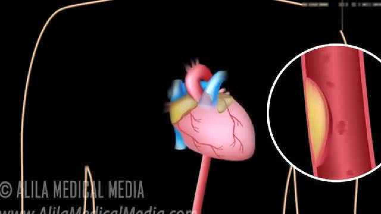 医学科普动画：心肌梗死是如何发生的？它是如何介入治疗的？_腾讯视频