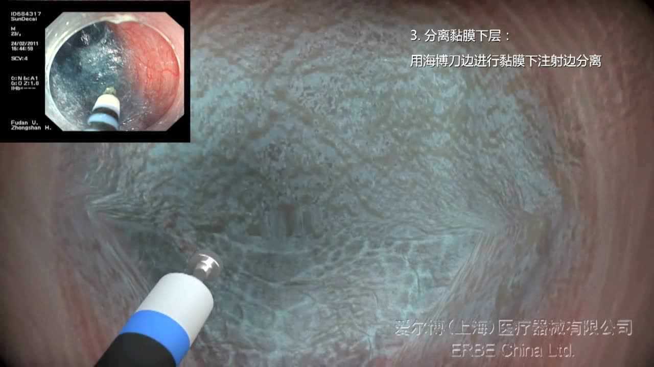 海博刀进行POEM手术_高清1080P在线观看平台_腾讯视频