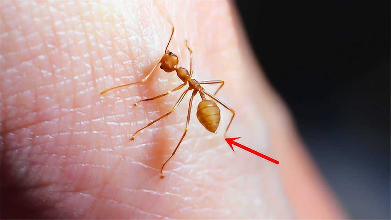 把手上的黄猄蚁激怒蚂蚁边撕咬边喷出蚁酸酸滴清晰可见