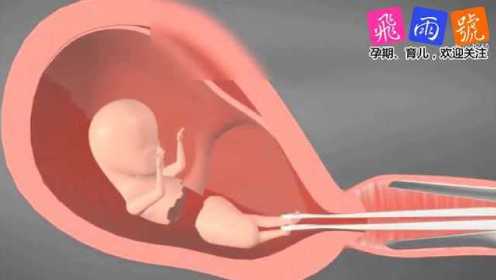 人工流产时 胎儿是这样被医生用夹子夹出来的 感觉是在残害生命