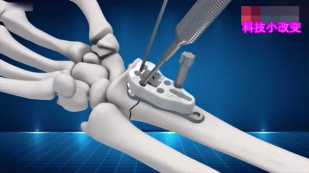 3d演示骨折打钢钉过程,真是看着都疼!身体还是要爱惜