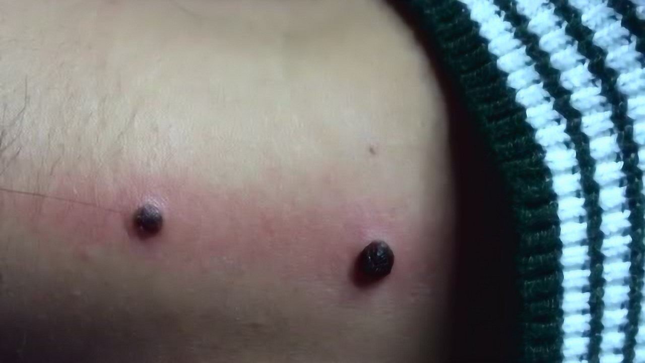 血管大肉痣祛除完成