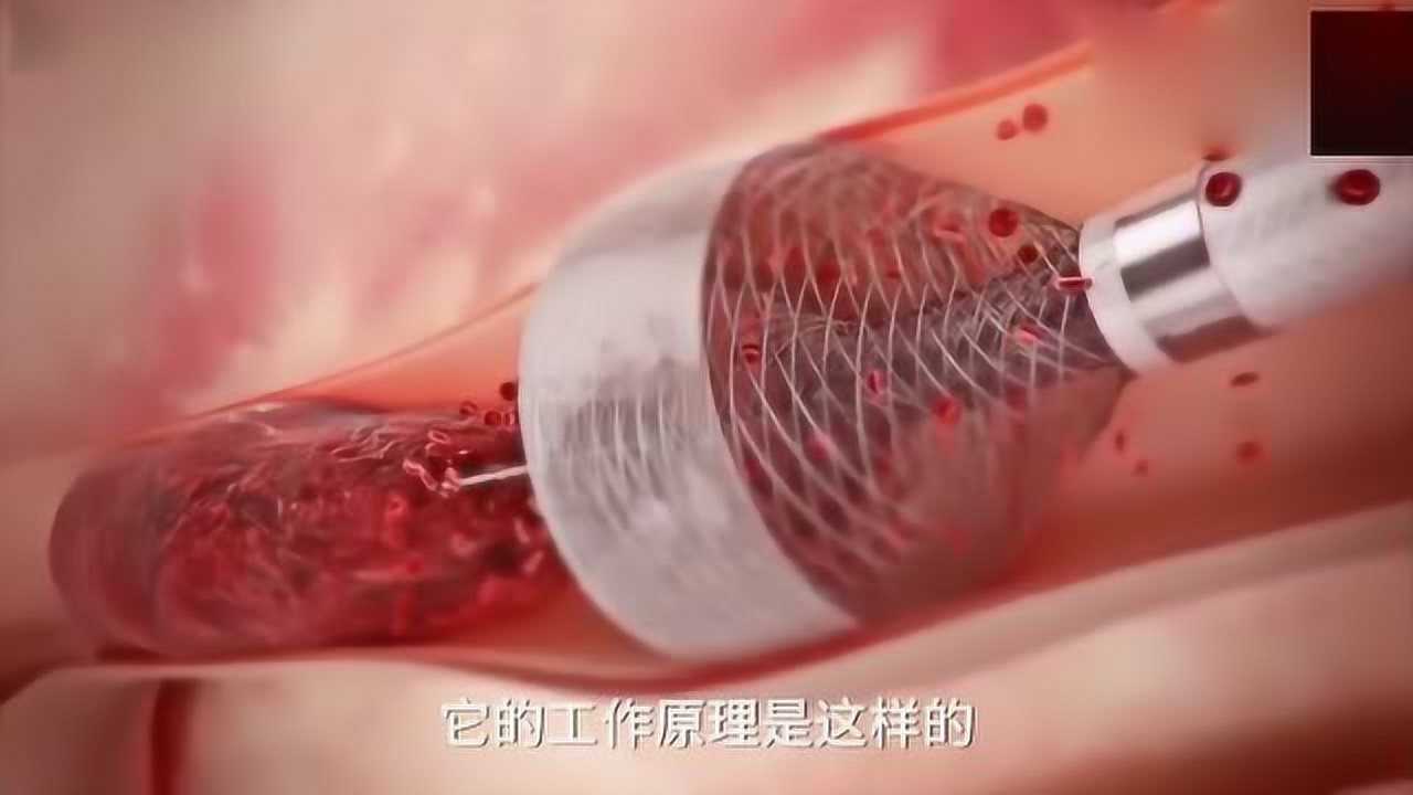 血栓切除术，两分钟内清除血栓，看完感觉真舒服！_高清