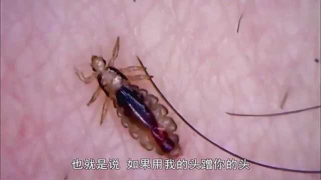 显微镜下头虱长什么样?头虱是以什么为食物?