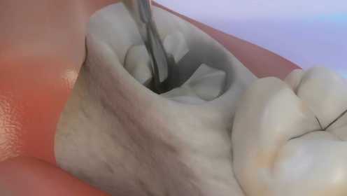 你知道牙医是如何补牙的吗？3D展示补牙过程，隔着屏幕都觉得疼