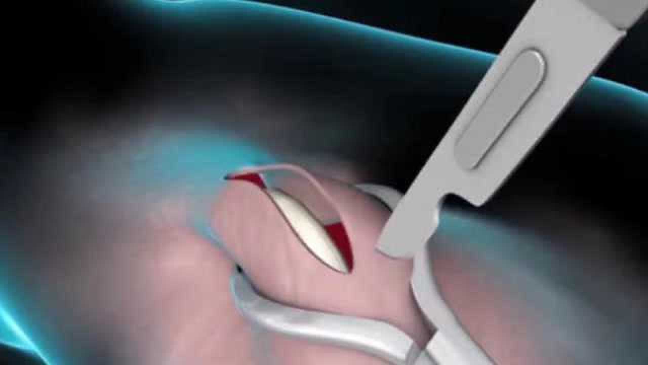 男人结扎手术是怎样做的真人手术全过程看着都心疼