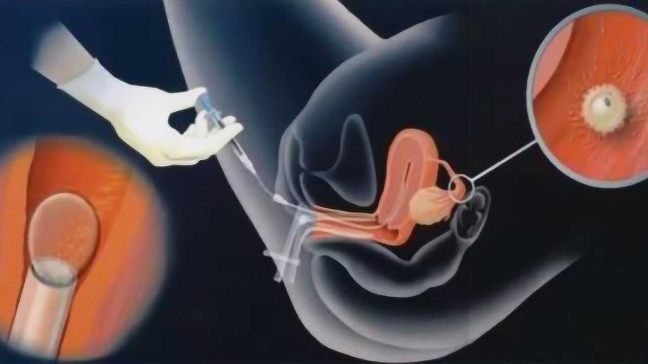 女性做试管婴儿到底有多疼?3d模拟全过程,看完心疼妈妈们!