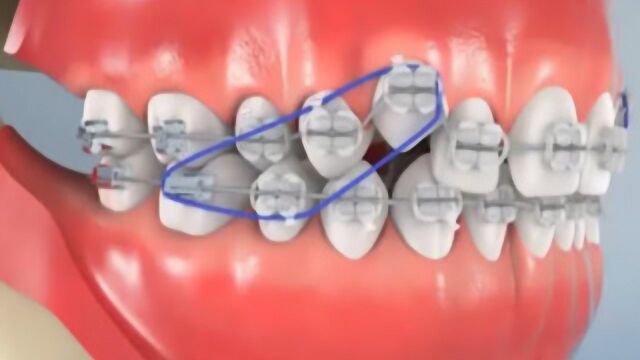 戴牙套是怎么矫正牙齿的?3D动画演示全过程,看着都有点疼