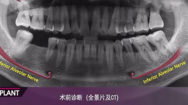 5分钟了解种植牙全过程,牙齿缺失了种一颗和真牙一样